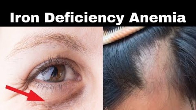 'Treat Anemia, Iron deficiency Naturally | Increase Hemoglobin level Naturally'